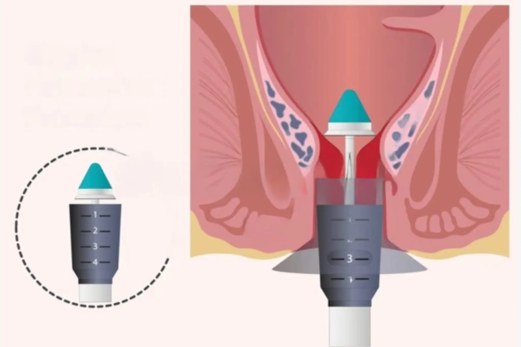 Stapler Circumcision in Pune